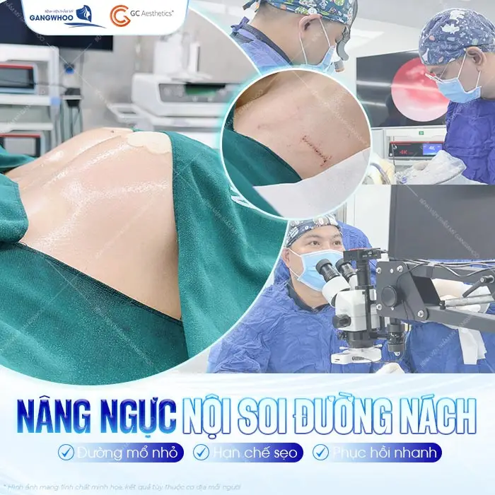 Nâng ngực nội soi đường nách đường mổ nhỏ, hạn chế sẹo và phục hồi nhanh