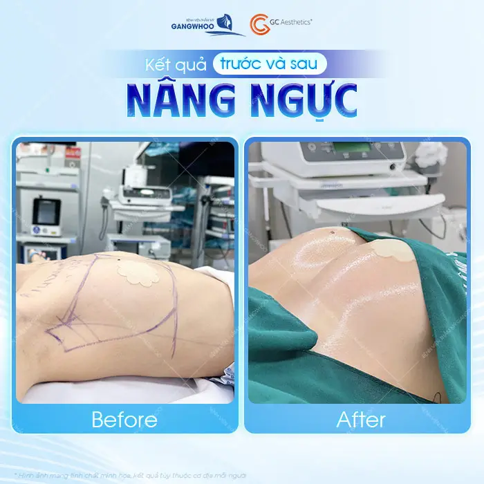 Kết quả thay đổi đầy ngoạn mục của chị Ly trước và sau can thiệp phẫu thuật