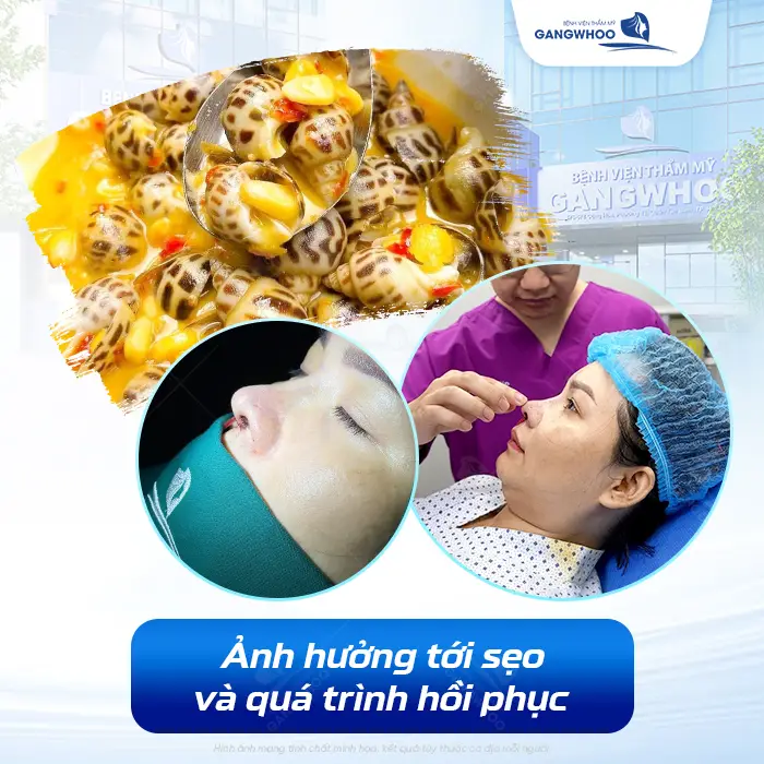 Nâng Mũi Ăn Được Ốc Không? Bao Lâu Ăn Ốc Được?
