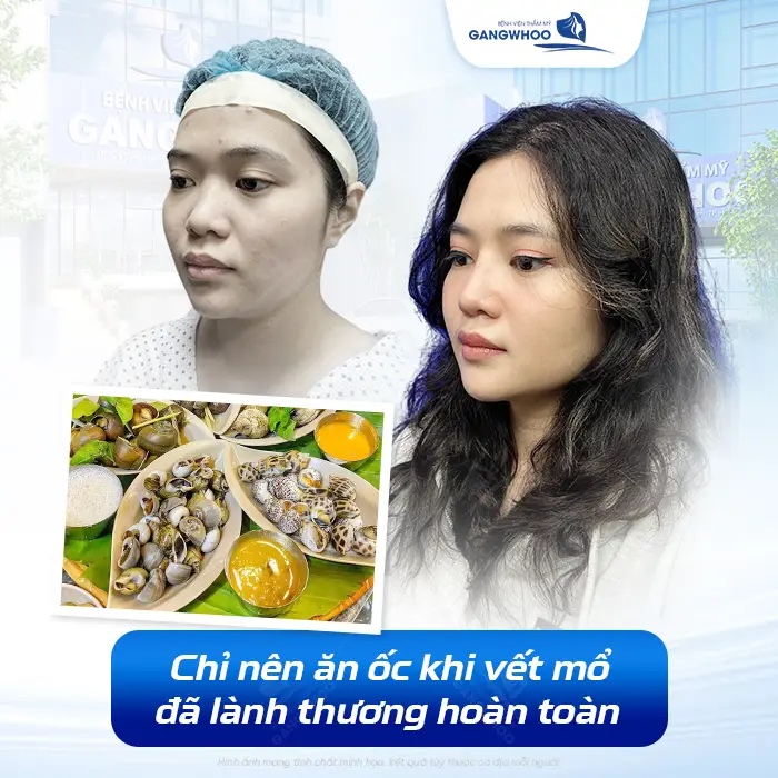 Nâng Mũi Ăn Được Ốc Không? Bao Lâu Ăn Ốc Được?