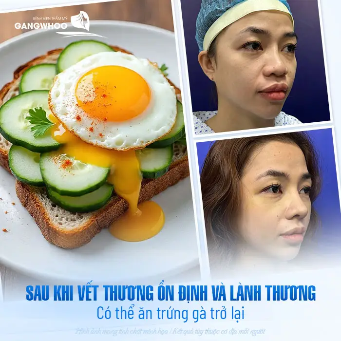 Nâng Mũi Bao Lâu Được Ăn Trứng Gà? Những Lưu Ý Quan Trọng 3 Nâng Mũi Bao Lâu Được Ăn Trứng Gà? Những Lưu Ý Quan Trọng