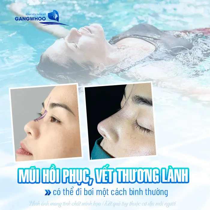 Nâng Mũi Bao Lâu Đi Bơi Được? Những Lưu Ý Khi Đi Bơi 2 Khi mũi hồi phục, vết thương lành có thể đi bơi lại một cách bình thường