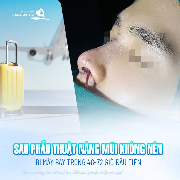 Nâng Mũi Bao Lâu Thì Đi Máy Bay Được? Mốc Thời Gian Bay Nội Địa, Quốc Tế 1 Nâng Mũi Bao Lâu Thì Đi Máy Bay Được? Mốc Thời Gian Bay Nội Địa, Quốc Tế