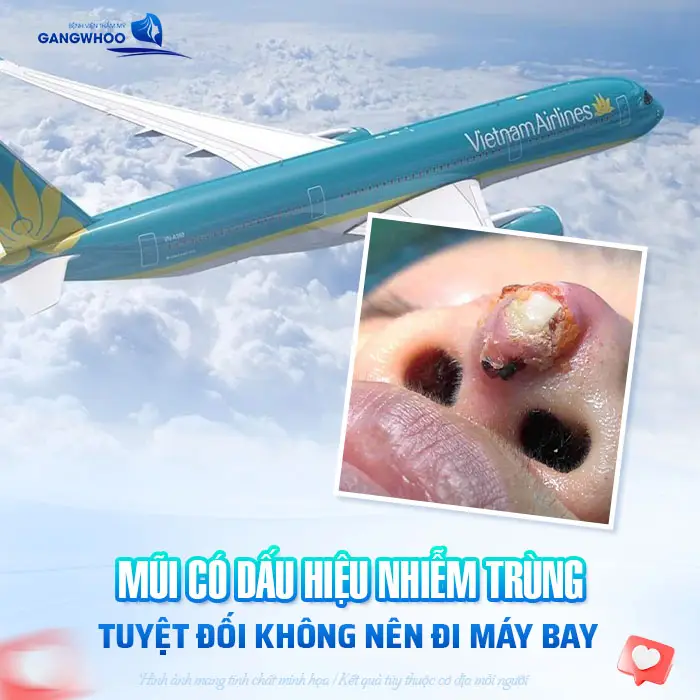 Nâng Mũi Bao Lâu Thì Đi Máy Bay Được? Mốc Thời Gian Bay Nội Địa, Quốc Tế 5 Nâng Mũi Bao Lâu Thì Đi Máy Bay Được? Mốc Thời Gian Bay Nội Địa, Quốc Tế