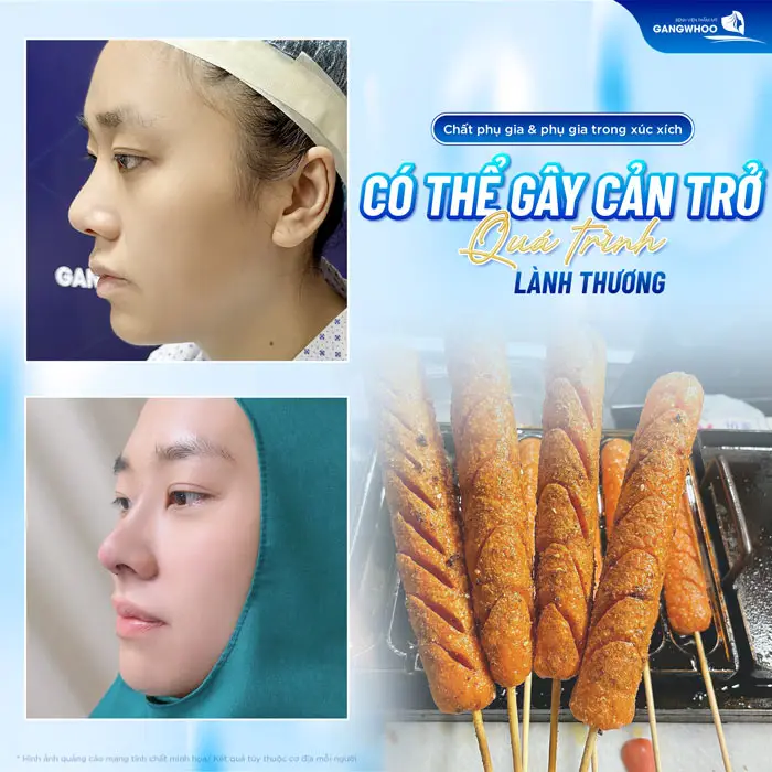 Trong xúc xích có nhiều chất phụ gia có thể gây ra nhiều cản trở quá trình lành thương