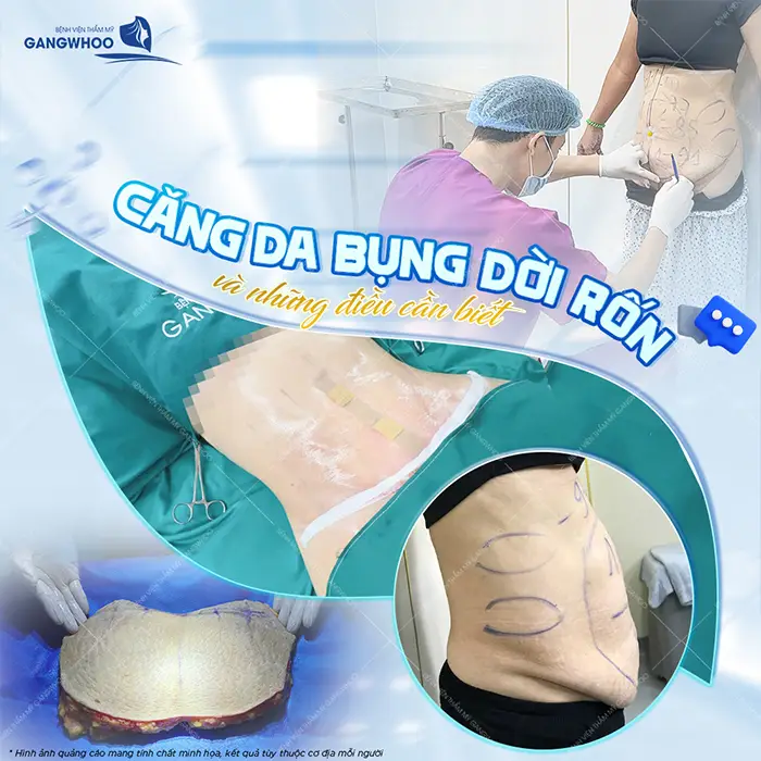 Phẫu Thuật Căng Da Bụng Bao Nhiêu Tiền? Bảng Giá Mới 2026 2 Phẫu Thuật Căng Da Bụng Bao Nhiêu Tiền? Bảng Giá Mới 2025