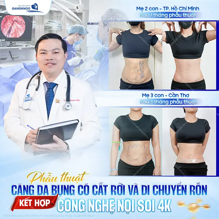 Phẫu Thuật Căng Da Bụng Bao Nhiêu Tiền? Bảng Giá Mới 2026 5 Phẫu Thuật Căng Da Bụng Bao Nhiêu Tiền? Bảng Giá Mới 2025