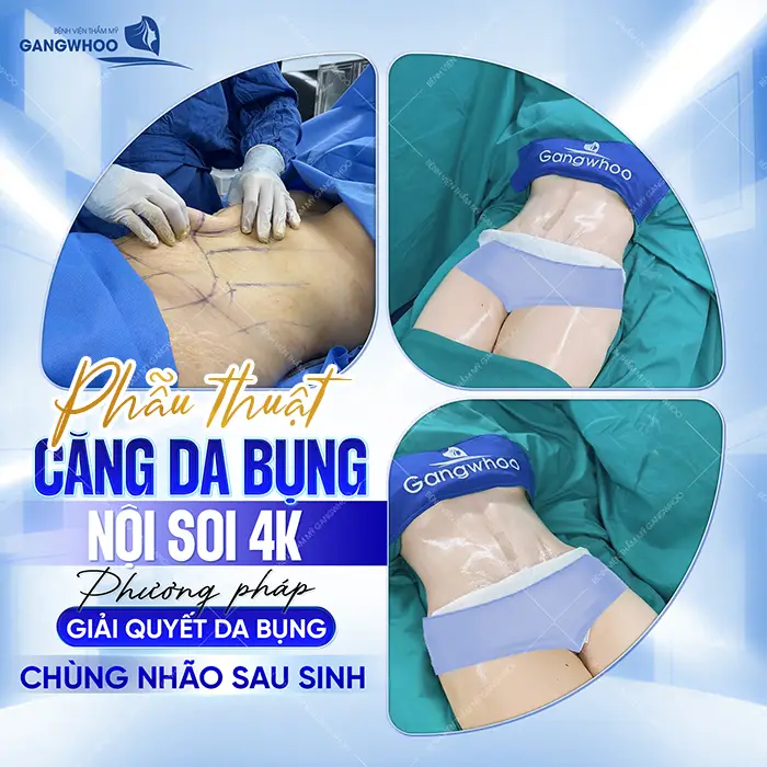 Phẫu Thuật Căng Da Bụng Bao Nhiêu Tiền? Bảng Giá Mới 2026 4 Phẫu Thuật Căng Da Bụng Bao Nhiêu Tiền? Bảng Giá Mới 2025