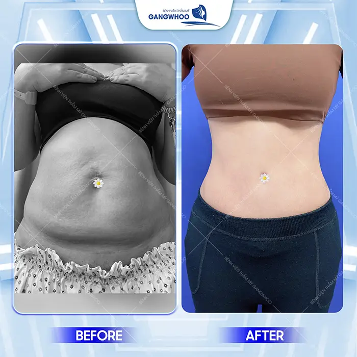 Phẫu Thuật Căng Da Bụng Bao Nhiêu Tiền? Bảng Giá Mới 2026 3 Phẫu Thuật Căng Da Bụng Bao Nhiêu Tiền? Bảng Giá Mới 2025