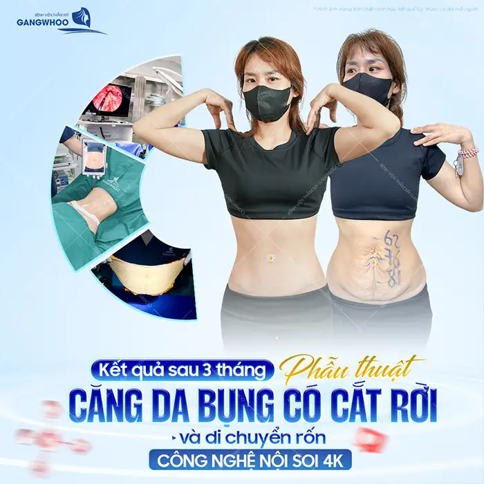 Phẫu Thuật Căng Da Bụng Bao Nhiêu Tiền? Bảng Giá Mới 2026 6 Phẫu Thuật Căng Da Bụng Bao Nhiêu Tiền? Bảng Giá Mới 2025