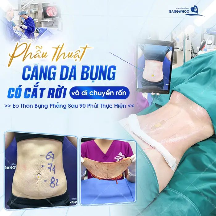 Phẫu Thuật Căng Da Bụng Bao Nhiêu Tiền? Bảng Giá Mới 2026 1 Phẫu Thuật Căng Da Bụng Bao Nhiêu Tiền? Bảng Giá Mới 2025