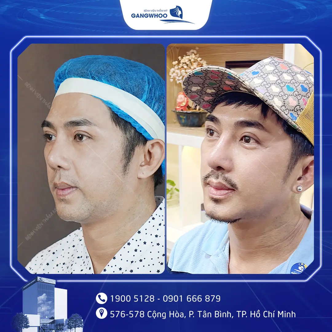 sua mui hong nam 3