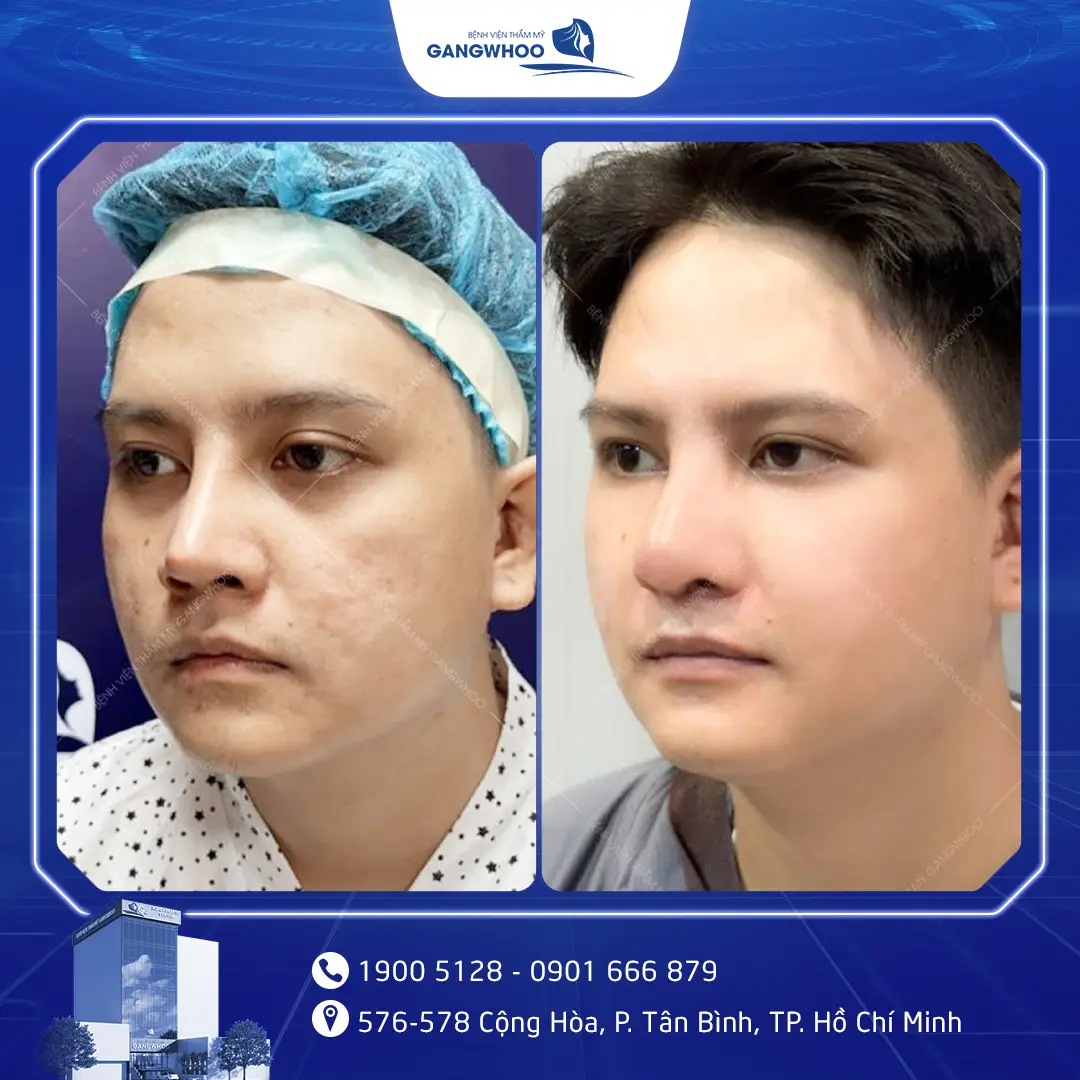 sua mui hong nam 4