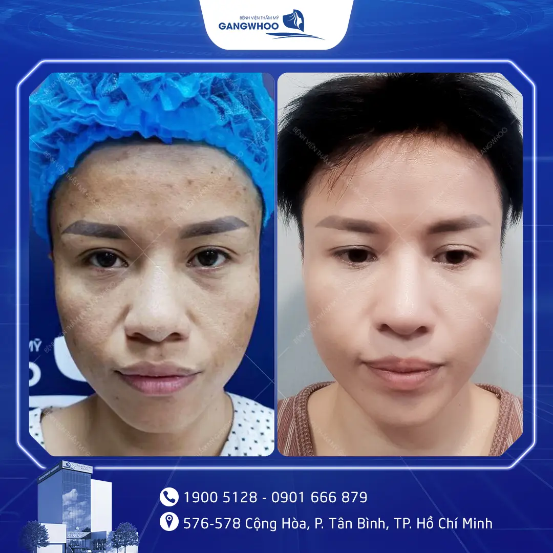 sua mui hong nam 5