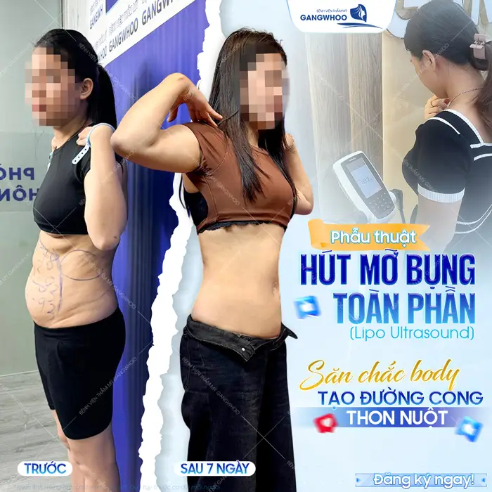 Top 10 Bác Sĩ Hút Mỡ Bụng Tại TPHCM Có Tiếng, Chuyên Môn Cao 2 Top 10 Bác Sĩ Hút Mỡ Bụng Tại TPHCM Có Tiếng, Chuyên Môn Cao
