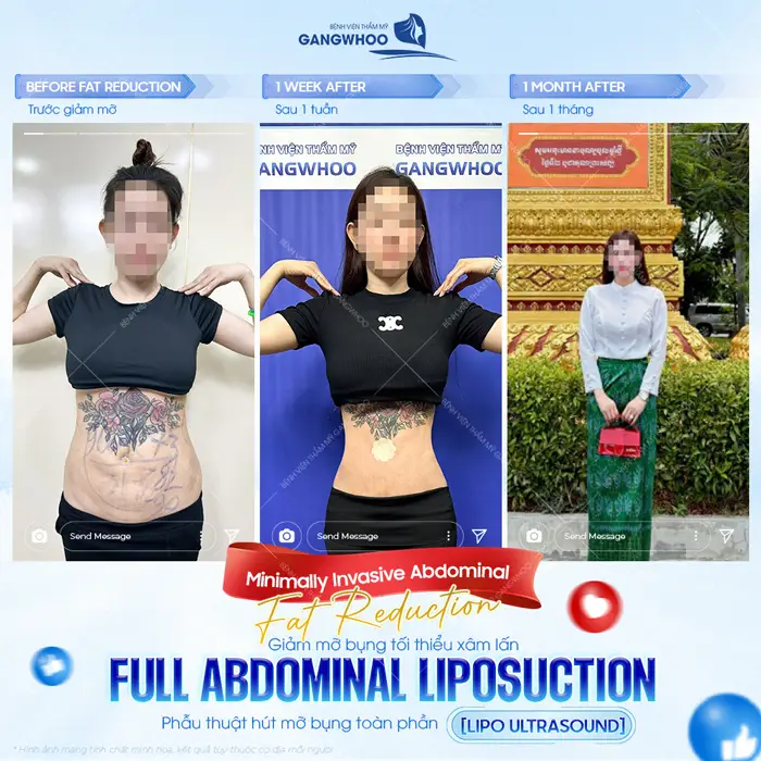 Top 10 Bác Sĩ Hút Mỡ Bụng Tại TPHCM Có Tiếng, Chuyên Môn Cao 6 Top 10 Bác Sĩ Hút Mỡ Bụng Tại TPHCM Có Tiếng, Chuyên Môn Cao