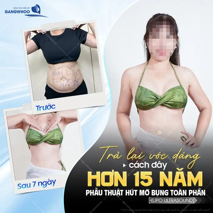 Top 10 Bác Sĩ Hút Mỡ Bụng Tại TPHCM Có Tiếng, Chuyên Môn Cao 1 Top 10 Bác Sĩ Hút Mỡ Bụng Tại TPHCM Có Tiếng, Chuyên Môn Cao