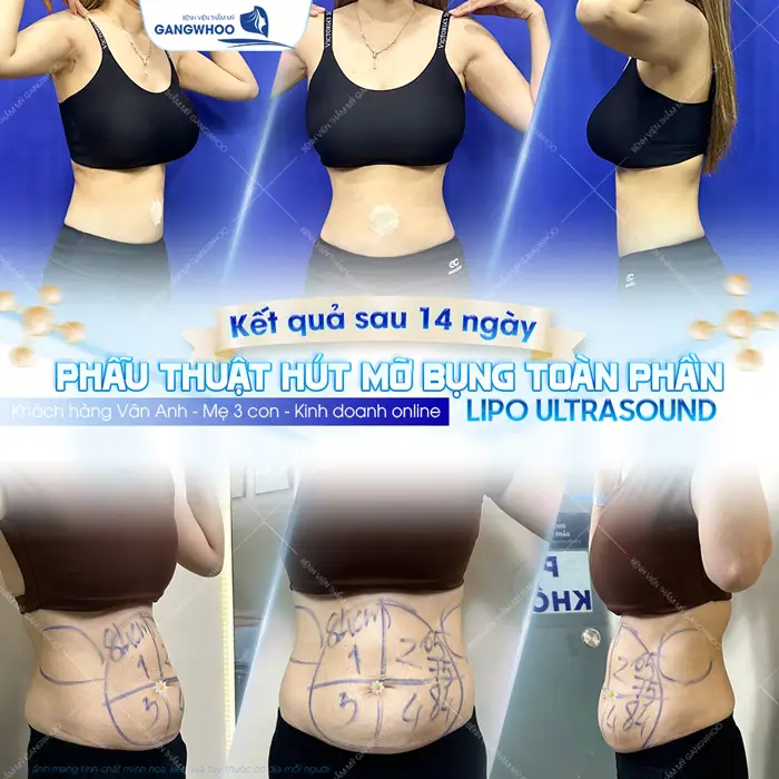 Top 10 Bác Sĩ Hút Mỡ Bụng Tại TPHCM Có Tiếng, Chuyên Môn Cao 7 Top 10 Bác Sĩ Hút Mỡ Bụng Tại TPHCM Có Tiếng, Chuyên Môn Cao