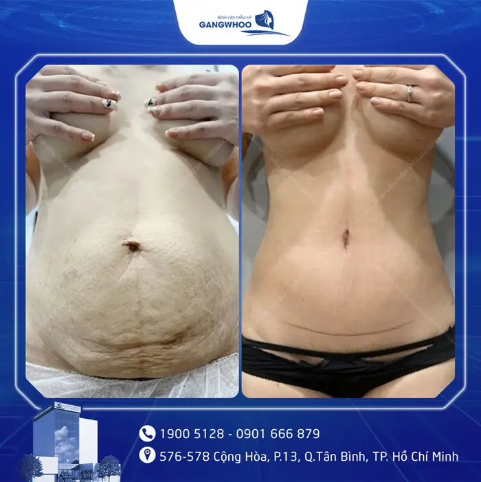 Phẫu Thuật Căng Da Bụng Sau Sinh: Quy Trình Và Chi Phí 5 cang da bung 1