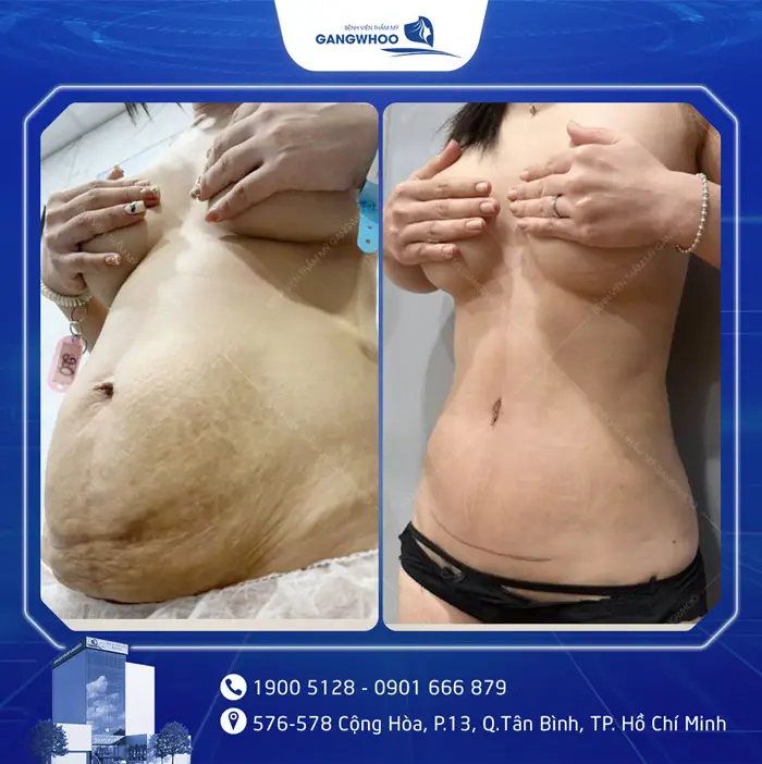 Phẫu Thuật Căng Da Bụng Sau Sinh: Quy Trình Và Chi Phí 6 cang da bung 2