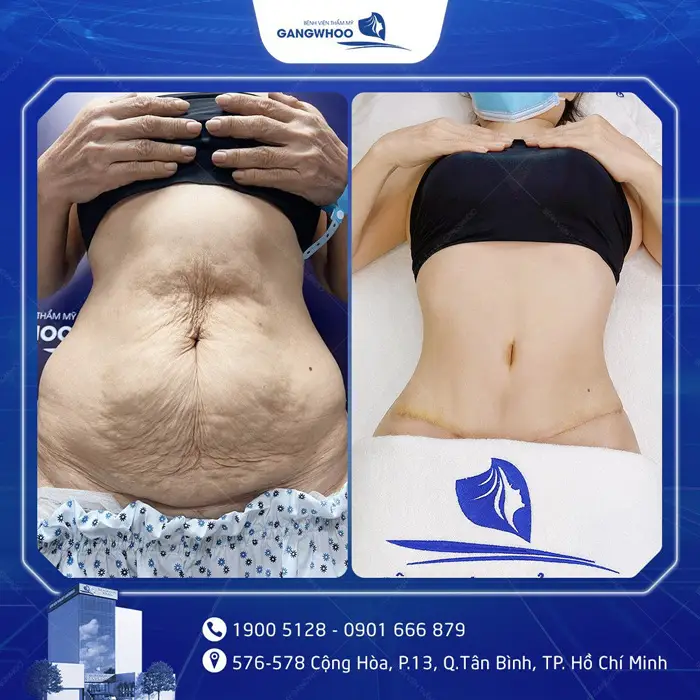 Phẫu Thuật Căng Da Bụng Sau Sinh: Quy Trình Và Chi Phí 9 cang da bung 4