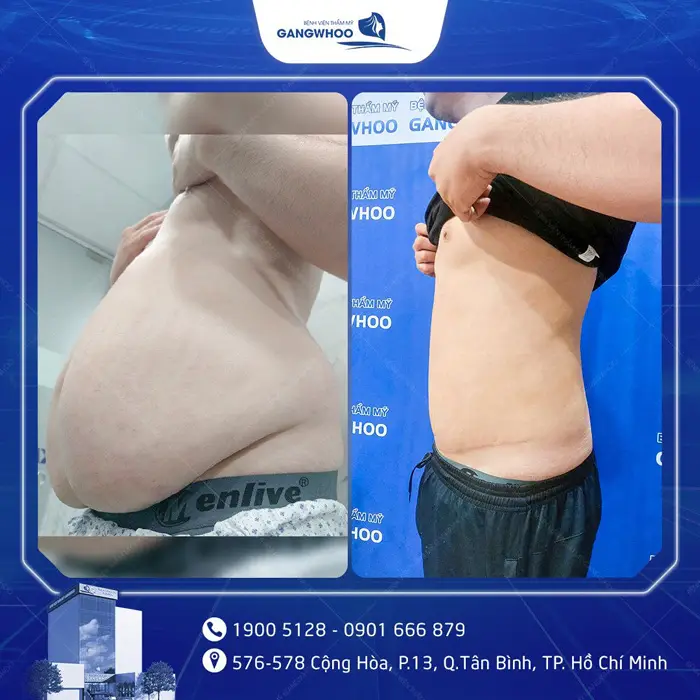 Phẫu Thuật Căng Da Bụng Sau Sinh: Quy Trình Và Chi Phí 10 cang da bung 5