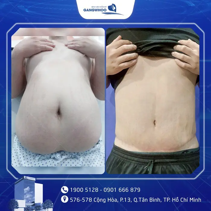 Phẫu Thuật Căng Da Bụng Sau Sinh: Quy Trình Và Chi Phí 11 cang da bung 6