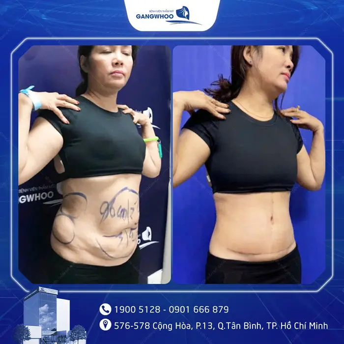 Phẫu Thuật Căng Da Bụng Sau Sinh: Quy Trình Và Chi Phí 8 cang da bung 7