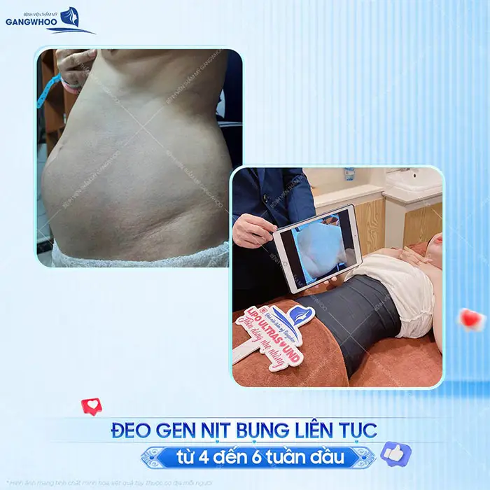 Căng Da Bụng Bao Lâu Thì Hồi Phục? Bác Sĩ Hướng Dẫn Chăm Sóc 3 Căng Da Bụng Bao Lâu Thì Hồi Phục? Bác Sĩ Hướng Dẫn Chăm Sóc