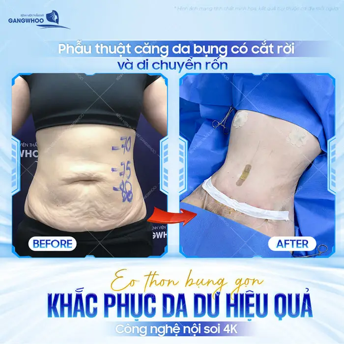 Căng Da Bụng Bao Lâu Thì Hồi Phục? Bác Sĩ Hướng Dẫn Chăm Sóc 2 Căng Da Bụng Bao Lâu Thì Hồi Phục? Bác Sĩ Hướng Dẫn Chăm Sóc