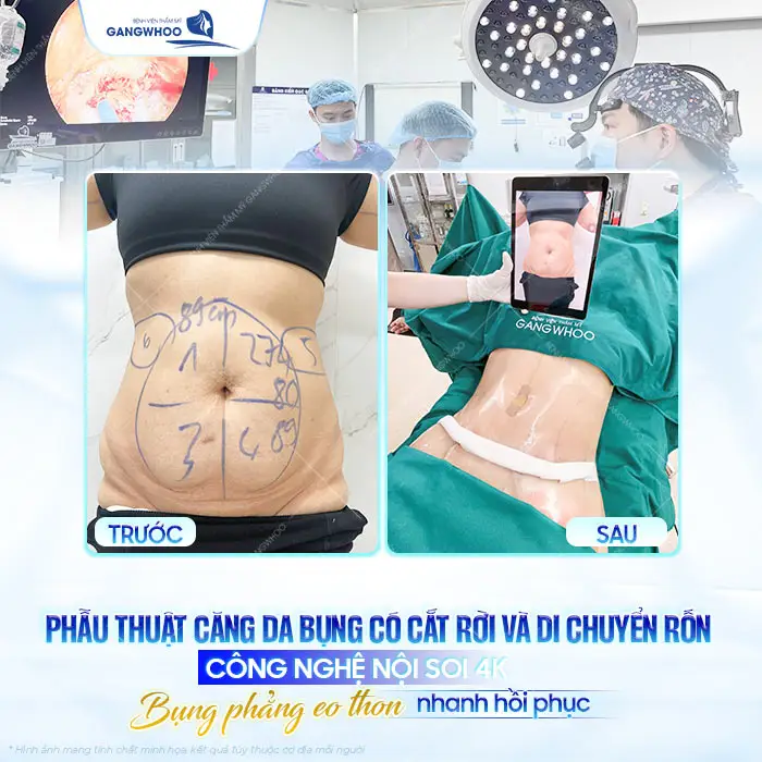 Căng Da Bụng Bao Lâu Thì Hồi Phục? Bác Sĩ Hướng Dẫn Chăm Sóc 4 Căng Da Bụng Bao Lâu Thì Hồi Phục? Bác Sĩ Hướng Dẫn Chăm Sóc