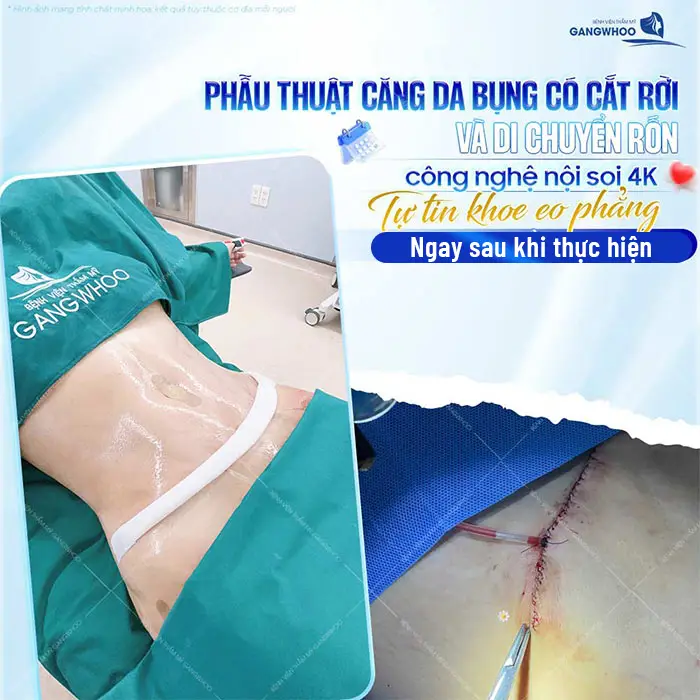 Căng Da Bụng Bao Lâu Thì Hồi Phục? Bác Sĩ Hướng Dẫn Chăm Sóc 1 Căng Da Bụng Bao Lâu Thì Hồi Phục? Bác Sĩ Hướng Dẫn Chăm Sóc