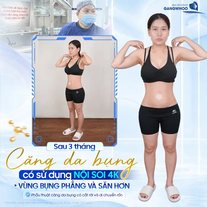 Kết quả sau 3 tháng căng da bụng có sử dụng công nghệ nội soi 4K vùng bụng phẳng và săn gọn hơn 