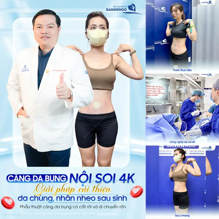 Căng da bụng nội soi 4K giải pháp cải thiện da chùng, nhăn nheo sau sinh 