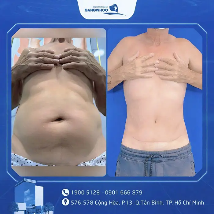 Phẫu Thuật Căng Da Bụng Sau Sinh: Quy Trình Và Chi Phí 4 cang da bung