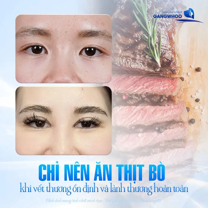Cắt Mí Mắt Kiêng Thịt Bò Bao Lâu? Bác Sĩ Giải Đáp