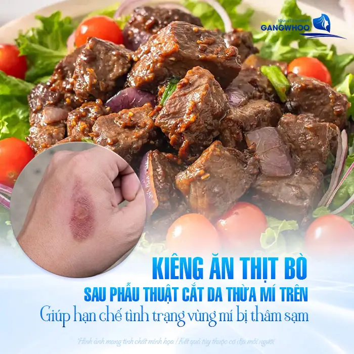 Cắt Mí Mắt Kiêng Thịt Bò Bao Lâu? Bác Sĩ Giải Đáp