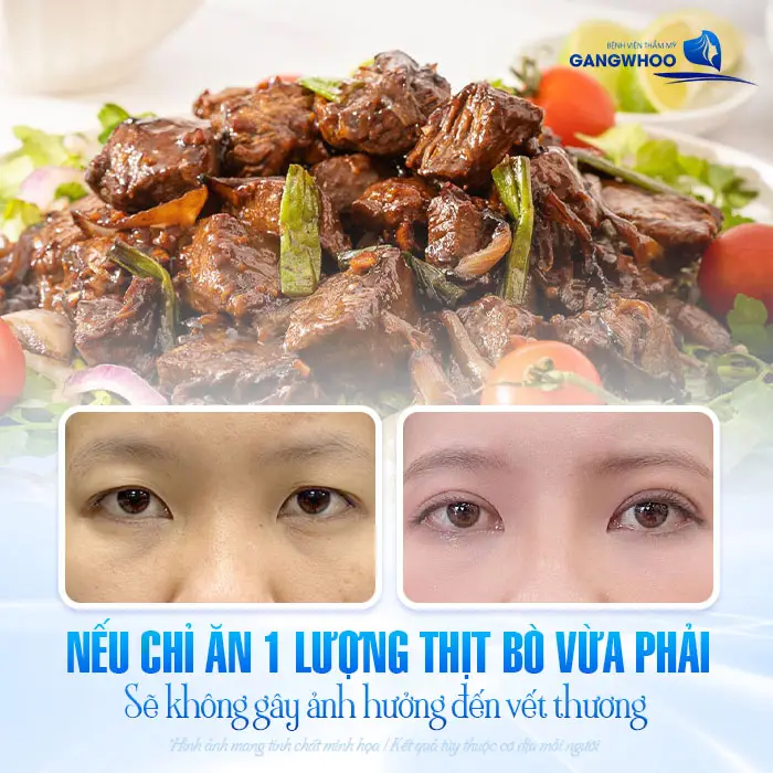 Cắt Mí Mắt Kiêng Thịt Bò Bao Lâu? Bác Sĩ Giải Đáp