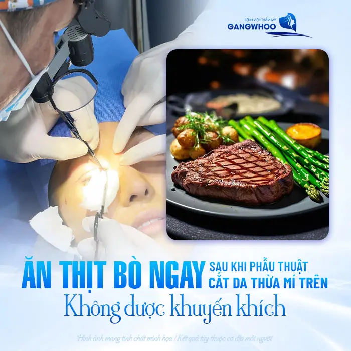 Cắt Mí Mắt Kiêng Thịt Bò Bao Lâu? Bác Sĩ Giải Đáp