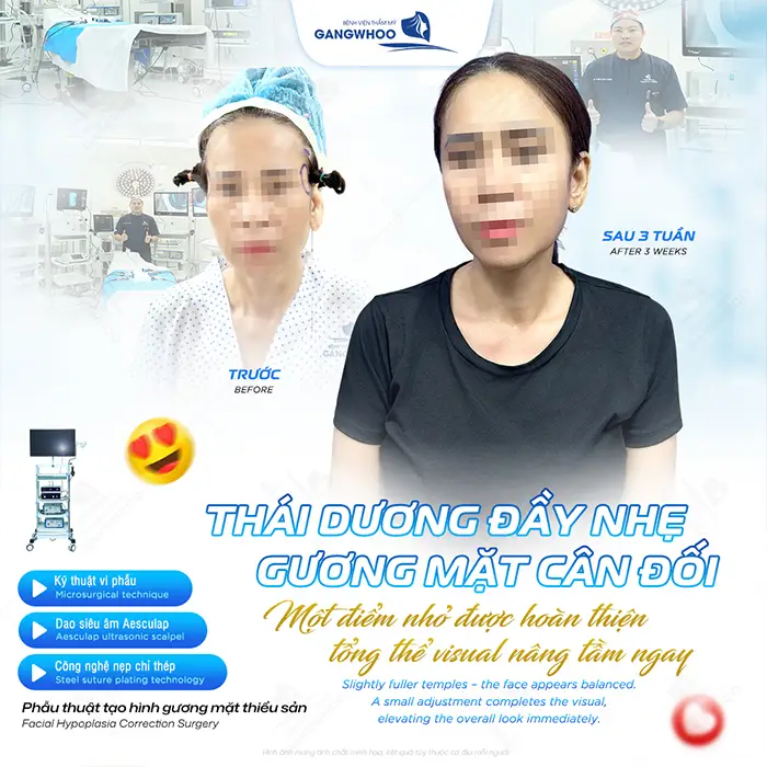 Độn Thái Dương Bằng Chất Liệu Gì? 3 Chất Liệu Thường Dùng