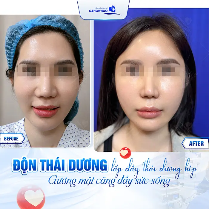 Độn Thái Dương Bằng Chất Liệu Gì? 3 Chất Liệu Thường Dùng