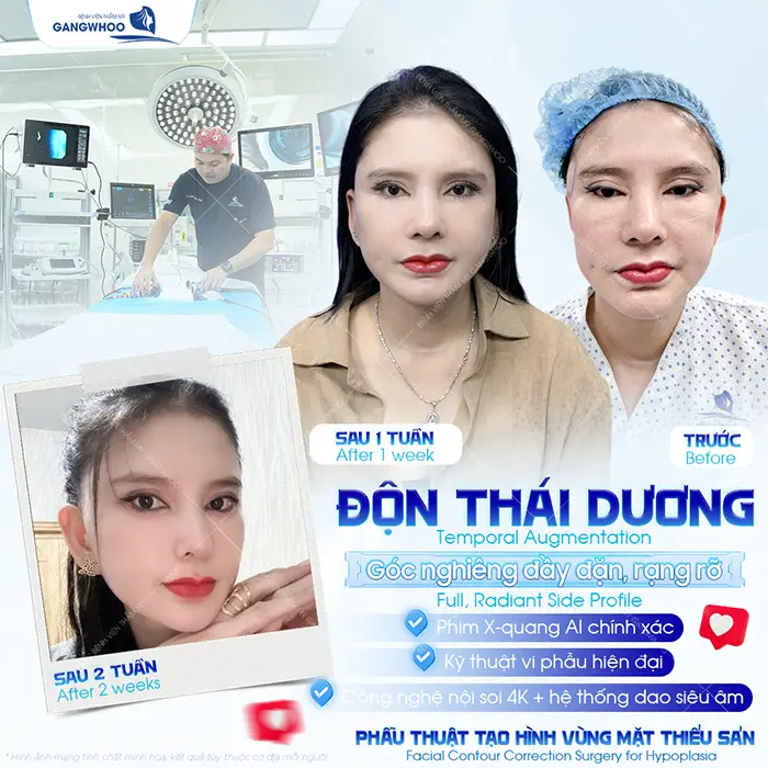 Độn Thái Dương Bằng Chất Liệu Gì? 3 Chất Liệu Thường Dùng