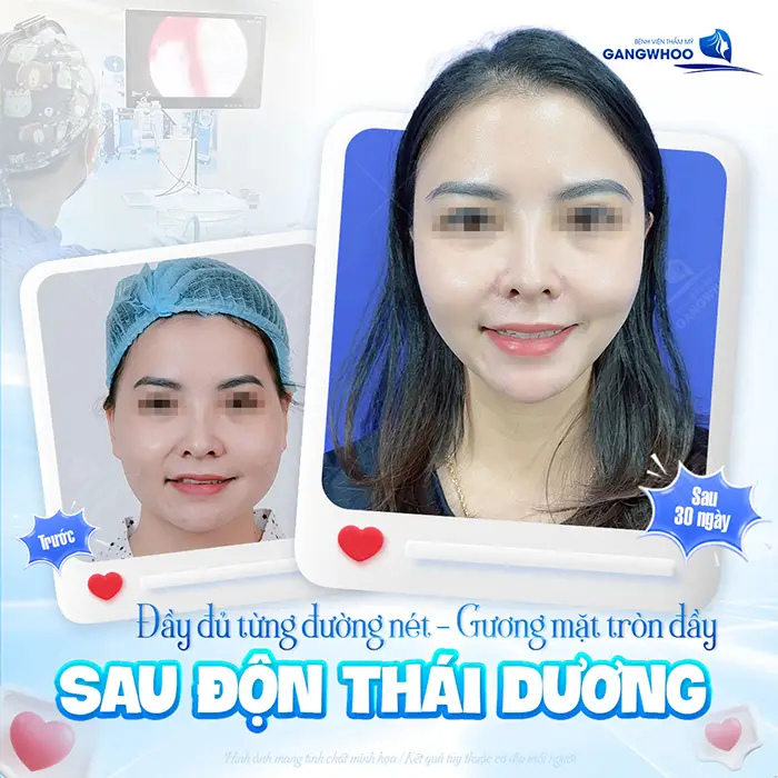 Độn Thái Dương Bị Lệch - Nguyên Nhân, Dấu Hiệu Và Cách Xử Lý 2 Độn Thái Dương Bị Lệch - Nguyên Nhân, Dấu Hiệu Và Cách Xử Lý