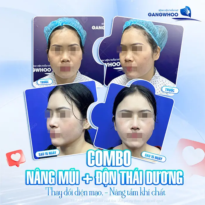 Độn Thái Dương Bị Lệch - Nguyên Nhân, Dấu Hiệu Và Cách Xử Lý 3 Độn Thái Dương Bị Lệch - Nguyên Nhân, Dấu Hiệu Và Cách Xử Lý