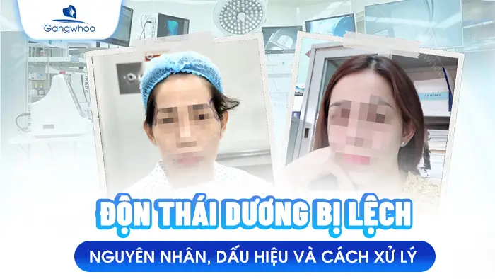 don thai duong bi lech