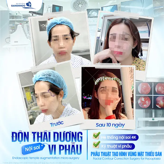 Độn Thái Dương Có Bị Lộ Không? Nguyên Nhân Và Cách Xử Lý