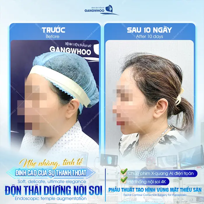 Độn Thái Dương Có Bị Lộ Không? Nguyên Nhân Và Cách Xử Lý