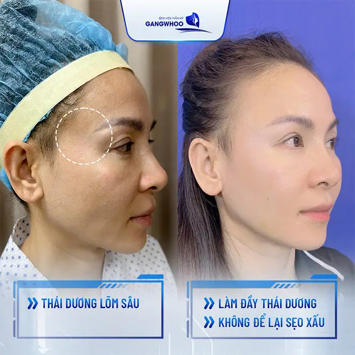 Độn Thái Dương Có Bị Lộ Không? Nguyên Nhân Và Cách Xử Lý