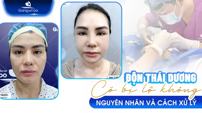 don thai duong co bi lo khong