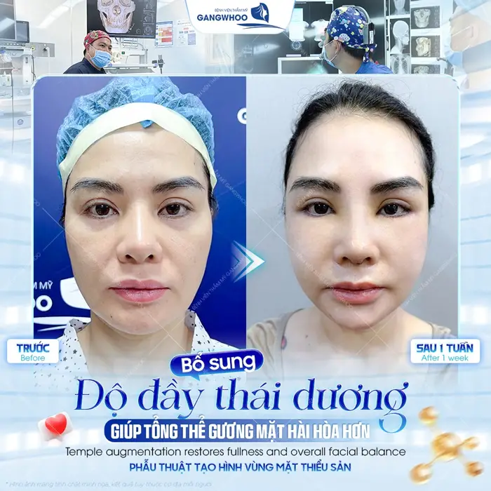 Độn thái dương giúp gương mặt tổnt thể hài hòa hơn sau 1 tuần diện mạo và thần sắc đã thăng hạng thấy rõ